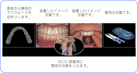 まずは歯の表面を綺麗にお掃除します→お口に装着前に専用のお薬を入れます。→歯茎を保護し特殊なお薬を塗布します。→15分間を3回、計45分間、光を照射します。→専用の機械で光を照射する前にお口を固定して唇を保護します