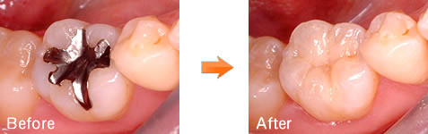 銀歯の除去症例